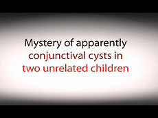 Cornée, Pathologies Externes - Un mystérieux kyste, apparemment conjonctival, dans dans deux enfants non apparentés Cornée, Pathologies Externes - Un mystérieux kyste, apparemment conjonctival, dans dans deux enfants non apparentés