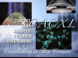 Cornée, Pathologies externes - Pose de lentilles de contact assistée par Cross-Linking pour les cornées minces