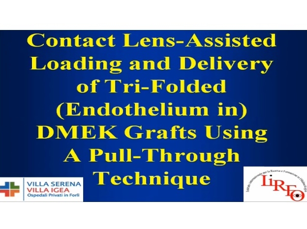 Cornea, External Disease - Contact Lens–Assisted Loading and Delivery of Tri-Folded (Endothelium-In) DMEK Grafts Using A Pull-Through Technique