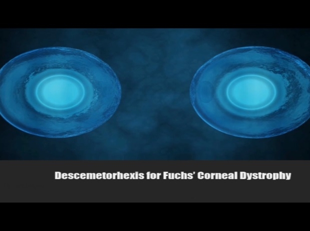 Cornea, External Disease - Descemetorhexis Without Transplantation for Fuchs' Dystrophy Cornea, External Disease - Descemetorhexis Without Transplantation for Fuchs' Dystrophy