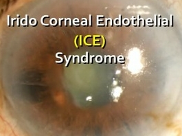 Cornée, Pathologies externes - DSEK Quadruple : une nouvelle solution pour l'œdème cornéen et le glaucome dans le syndrome irido-cornéen endothélial