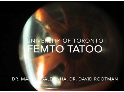 videousa/2015/2015-AAO/Cornea_External_Disease-Femto_Tattoo-Mario_John_Saldanha-David_Rootman.mp4 videousa/2015/2015-AAO/Cornea_External_Disease-Femto_Tattoo-Mario_John_Saldanha-David_Rootman.mp4