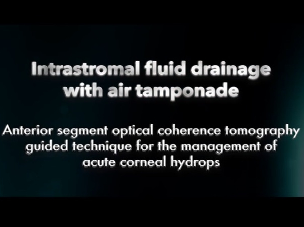 Cornea, External Disease - Intrastromal Fluid Drainage With Air Tamponade: Anterior Segment Optical Coherence Tomography–Guided Technique for the Management of Acute Corneal Hydrops