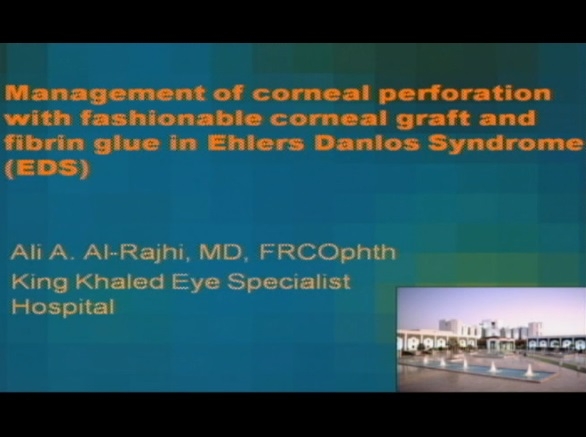 Cornea, External Disease - Management of Corneal Perforation in the Thin Corneas of Ehlers-Danlos Syndrome by Fashionable Corneal Graft and Fibrin Glue