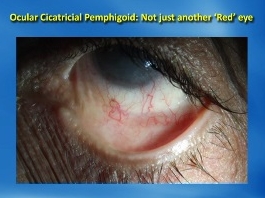 Cornée, Pathologies externes - Pemphigoïde cicatricielle oculaire : pas seulement un autre œil "rouge"