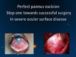 Cornée, Pathologies externes - Excision parfaite du pannus  : première étape vers une chirurgie réussie contre les maladies grâves de la surface oculaire Cornée, Pathologies externes - Excision parfaite du pannus  : première étape vers une chirurgie réussie contre les maladies grâves de la surface oculaire