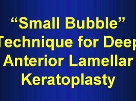 Cornée, Pathologies externes - Technique de la "petite bulle" pour la kératoplastie lamellaire antérieure profonde Cornée, Pathologies externes - Technique de la "petite bulle" pour la kératoplastie lamellaire antérieure profonde