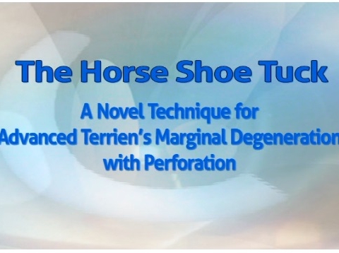 Cornea, External Disease - The Horseshoe Tuck: A Novel Technique for Advanced Terrien's Marginal Degeneration With Perforation