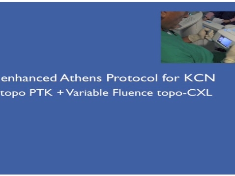 Cornea, External Disease - Topographic Implementation of UV-A Fluence on Customized Corneal Cross-Linking for Progressive Keratoconus Management (Modified Athens Protocol)