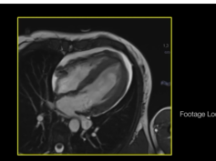 Coronavirus Myocarditis Magnetic Resonance Imaging (4-Chamber View)