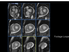 Coronavirus Myocarditis Magnetic Resonance Imaging (Short-Axis View)