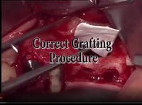Correct Grafting Procedure
