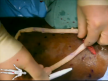 Creation of a Leg Arteriovenous Graft Creation of a Leg Arteriovenous Graft