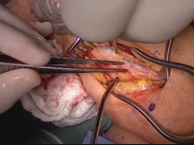 Creation of an Upper Arm Arteriovenous Graft Creation of an Upper Arm Arteriovenous Graft