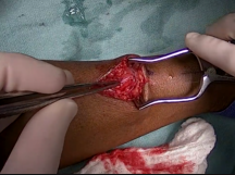Creation of Radiocephalic Fistula Creation of Radiocephalic Fistula