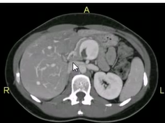 CT abdomen -Anatomy CT abdomen -Anatomy