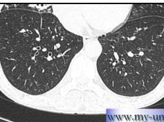 CT Chest - How to differentiate between pulmonary arteries and veins CT Chest - How to differentiate between pulmonary arteries and veins
