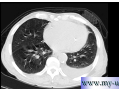 CT scan Chest - How to tell if a patient is a smoker CT scan Chest - How to tell if a patient is a smoker
