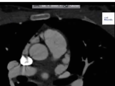 Ct scan chest Ct scan chest