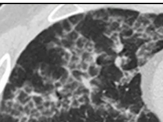 CT Scan -Crazy paving pattern CT Scan -Crazy paving pattern