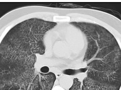 CT scan interpretation, Pulmonary alveolar proteinosis CT scan interpretation, Pulmonary alveolar proteinosis