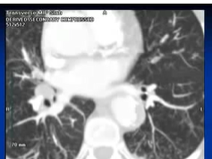 CT Scan -- Lungs "tree in bud" Sign CT Scan -- Lungs "tree in bud" Sign