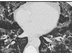 CT scan of chest, Ground-glass opacification CT scan of chest, Ground-glass opacification