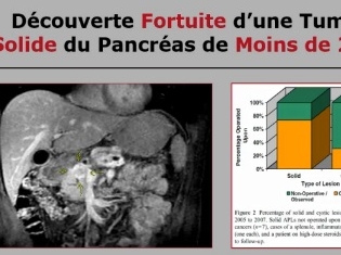 Découverte fortuite d’une tumeur solide du pancréas inférieure à 2 cm