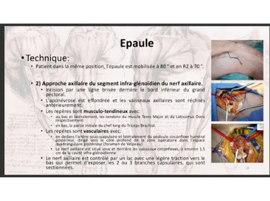 Dénervation partielle des articulations des membres supérieurs Dénervation partielle des articulations des membres supérieurs