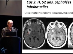 Déroutes opératoires (1/10) - Risques de la procédure microchirurgicale