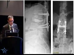 Déroutes opératoires (6/10) - Chirurgie sur os ostéoporotique : bonnes pratiques Déroutes opératoires (6/10) - Chirurgie sur os ostéoporotique : bonnes pratiques