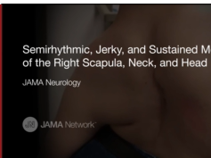 Dancing Dorsal Quadrilaterals Syndrome (Case 2) Dancing Dorsal Quadrilaterals Syndrome (Case 2)