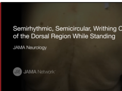 Dancing Dorsal Quadrilaterals Syndrome (Case 3) Dancing Dorsal Quadrilaterals Syndrome (Case 3)