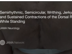 Dancing Dorsal Quadrilaterals Syndrome (Case 4) Dancing Dorsal Quadrilaterals Syndrome (Case 4)