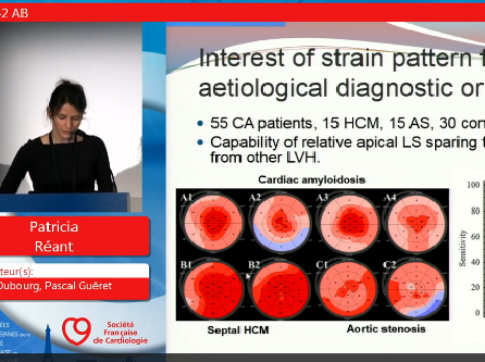 Dans la cardiomyopathie hypertrophique