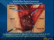 De Garengeots Hernia: A Report of Two Cases
