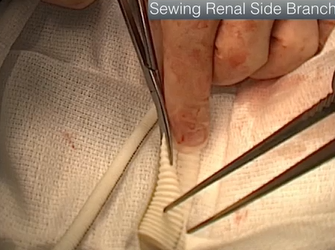 Dealing with Problematic Anastamoses (ALAN B. LUMSDEN, MD) Dealing with Problematic Anastamoses (ALAN B. LUMSDEN, MD)