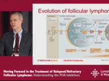 Debate: Watch and Wait in Follicular Lymphoma: Should We Treat Immediately? Debate: Watch and Wait in Follicular Lymphoma: Should We Treat Immediately?