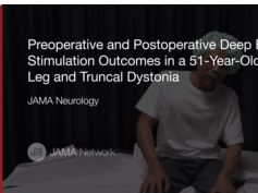 Deep Brain Stimulation Outcomes in a 51-Year-Old Man with Leg and Truncal Dystonia Deep Brain Stimulation Outcomes in a 51-Year-Old Man with Leg and Truncal Dystonia