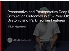 Deep Brain Stimulation Outcomes in a 52-Year-Old Man with Dystonic and Parkinsonian Features Deep Brain Stimulation Outcomes in a 52-Year-Old Man with Dystonic and Parkinsonian Features