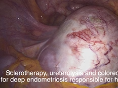 Deep endometriosis, large endometrioma, left hydronephrosis and rectal involvement Deep endometriosis, large endometrioma, left hydronephrosis and rectal involvement