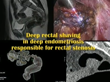 Deep Rectal Shaving Using Plasma Energy For Endometriosis Causing Rectal Stenosis Deep Rectal Shaving Using Plasma Energy For Endometriosis Causing Rectal Stenosis