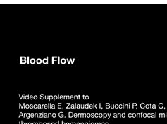 Dermoscopy and Confocal Microscopy of Thrombosed Hemangiomas