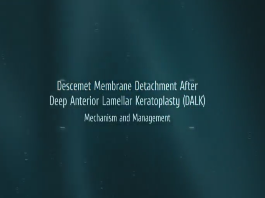 Descemet Membrane Detachment After Deep Anterior Lamellar Keratoplasty: Mechanism and Management Descemet Membrane Detachment After Deep Anterior Lamellar Keratoplasty: Mechanism and Management