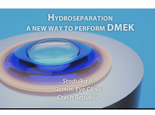 Descemet Membrane Endothelial Keratoplasty by Hydroseparation Descemet Membrane Endothelial Keratoplasty by Hydroseparation