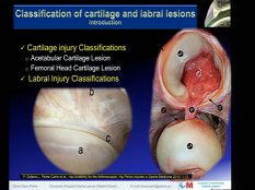 Description et classification des cartilages et lésions labrales