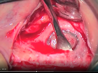 Detachment of the sinus mucosa