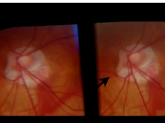 Detection of Progressive Glaucomatous Optic Neuropathy Using Automated Alternation Flicker With Ster 2 Detection of Progressive Glaucomatous Optic Neuropathy Using Automated Alternation Flicker With Ster 2
