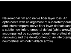 Detection of Progressive Glaucomatous Optic Neuropathy Using Automated Alternation Flicker With Ster 3 Detection of Progressive Glaucomatous Optic Neuropathy Using Automated Alternation Flicker With Ster 3