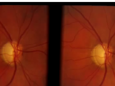 Detection of Progressive Glaucomatous Optic Neuropathy Using Automated Alternation Flicker With Ster Detection of Progressive Glaucomatous Optic Neuropathy Using Automated Alternation Flicker With Ster